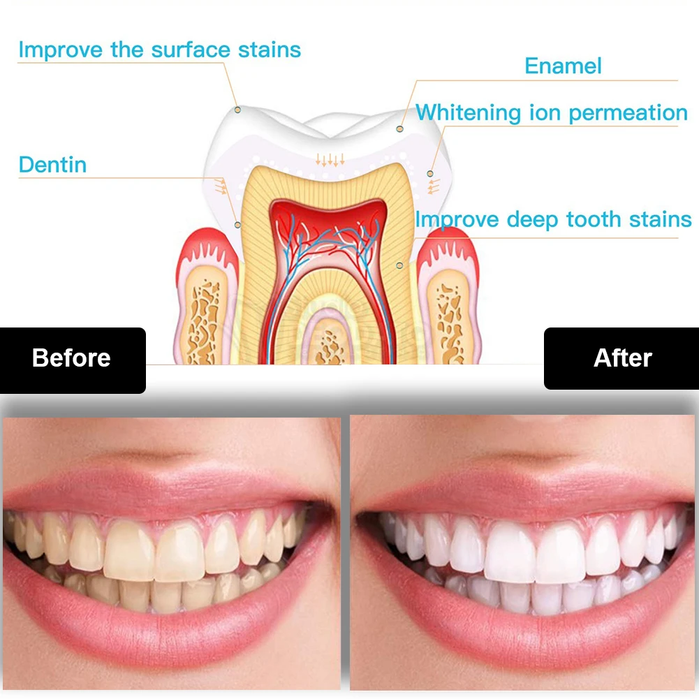 Kit per sbiancamento dei denti - Teeth Whitening Device recensione e prezzo